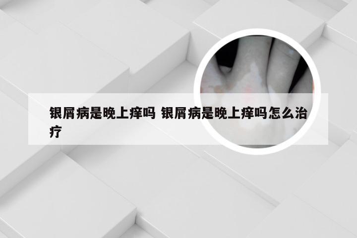 银屑病是晚上痒吗 银屑病是晚上痒吗怎么治疗