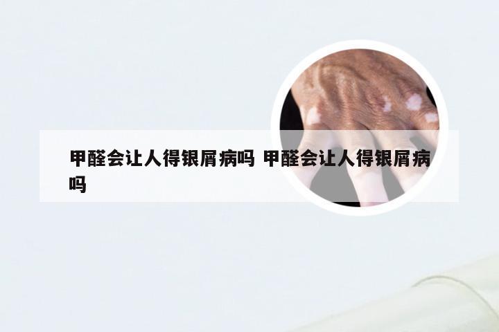 甲醛会让人得银屑病吗 甲醛会让人得银屑病吗