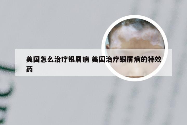 美国怎么治疗银屑病 美国治疗银屑病的特效药
