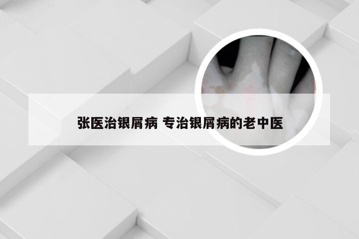 张医治银屑病 专治银屑病的老中医