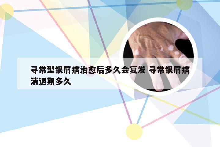 寻常型银屑病治愈后多久会复发 寻常银屑病消退期多久