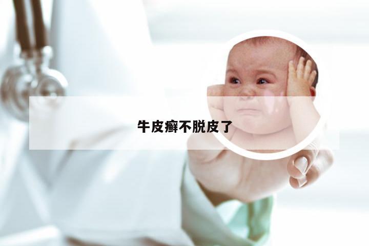 牛皮癣不脱皮了