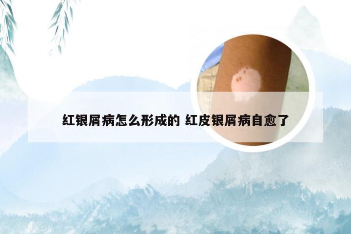 红银屑病怎么形成的 红皮银屑病自愈了