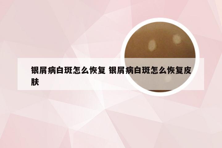银屑病白斑怎么恢复 银屑病白斑怎么恢复皮肤