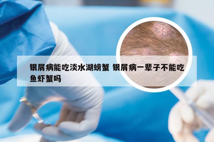 银屑病能吃淡水湖螃蟹 银屑病一辈子不能吃鱼虾蟹吗