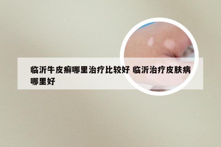临沂牛皮癣哪里治疗比较好 临沂治疗皮肤病哪里好