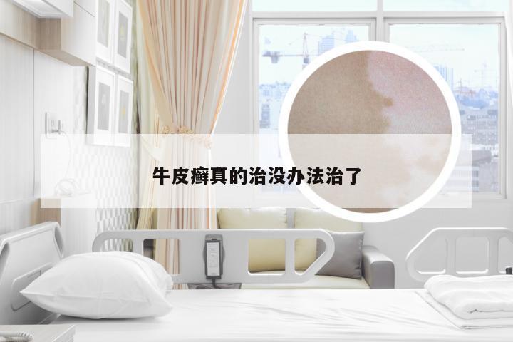 牛皮癣真的治没办法治了