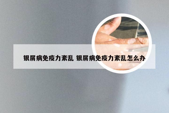 银屑病免疫力紊乱 银屑病免疫力紊乱怎么办