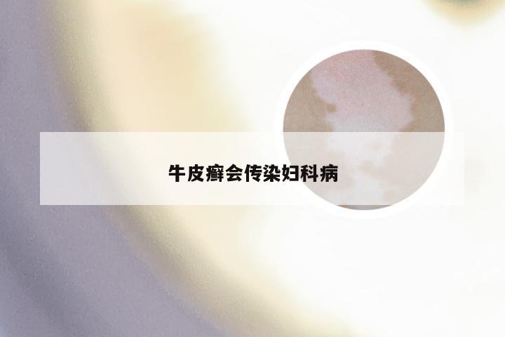牛皮癣会传染妇科病