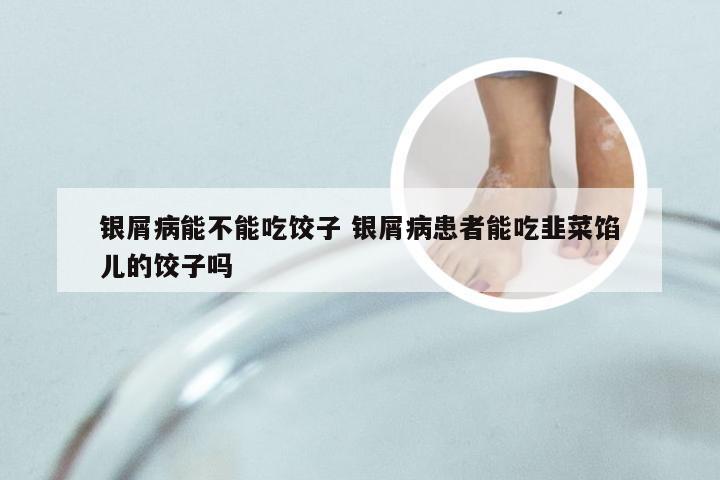银屑病能不能吃饺子 银屑病患者能吃韭菜馅儿的饺子吗