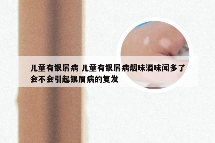 儿童有银屑病 儿童有银屑病烟味酒味闻多了会不会引起银屑病的复发