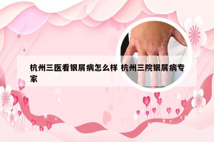 杭州三医看银屑病怎么样 杭州三院银屑病专家