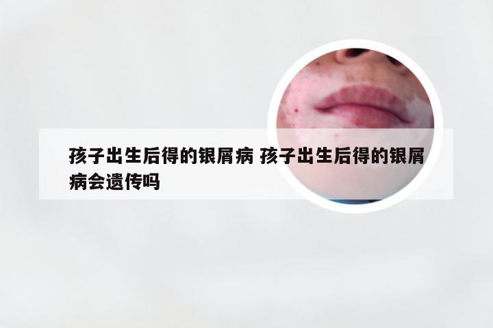 孩子出生后得的银屑病 孩子出生后得的银屑病会遗传吗