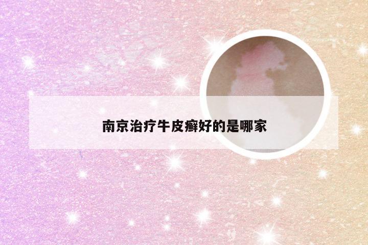 南京治疗牛皮癣好的是哪家