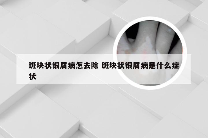 斑块状银屑病怎去除 斑块状银屑病是什么症状