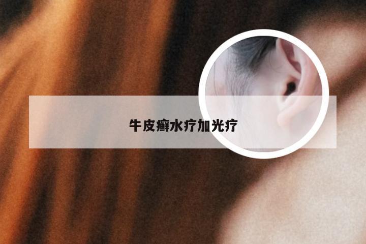 牛皮癣水疗加光疗