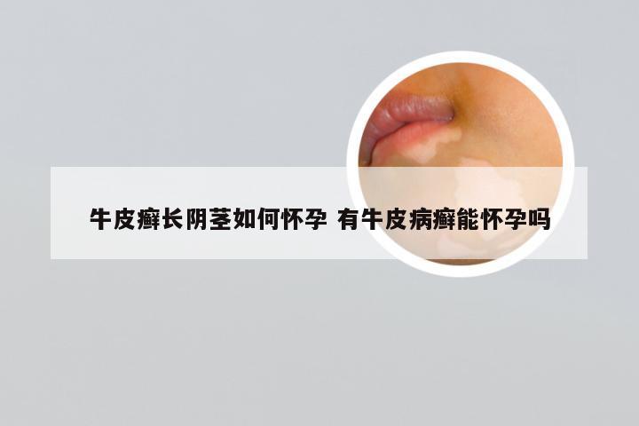 牛皮癣长阴茎如何怀孕 有牛皮病癣能怀孕吗