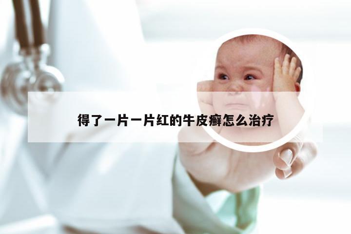 得了一片一片红的牛皮癣怎么治疗