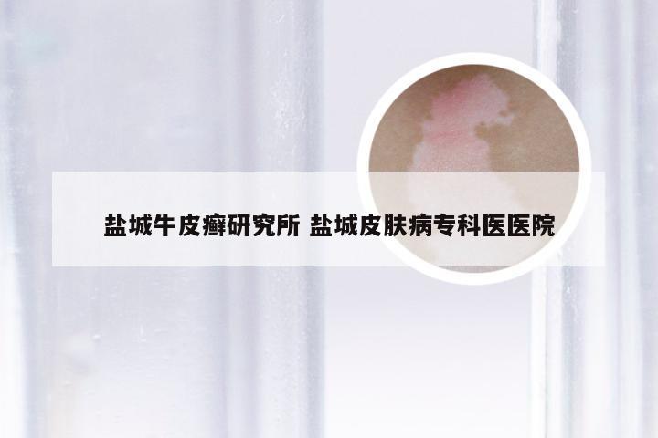 盐城牛皮癣研究所 盐城皮肤病专科医医院