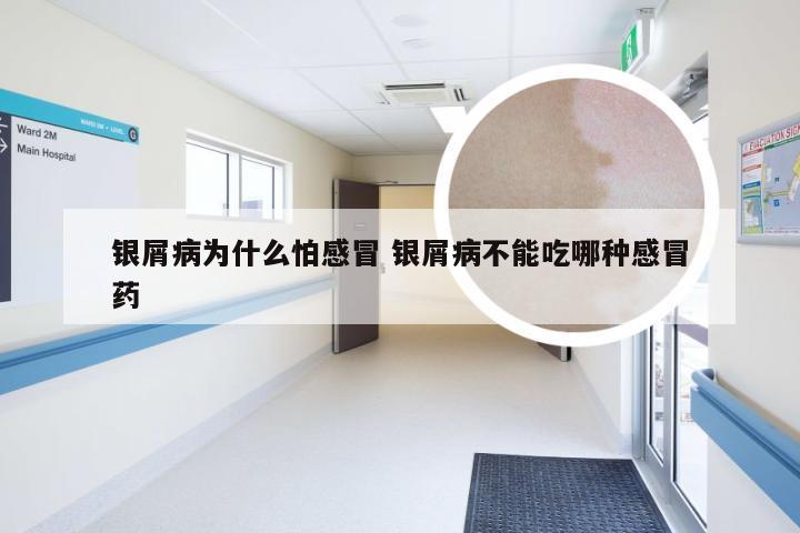 银屑病为什么怕感冒 银屑病不能吃哪种感冒药