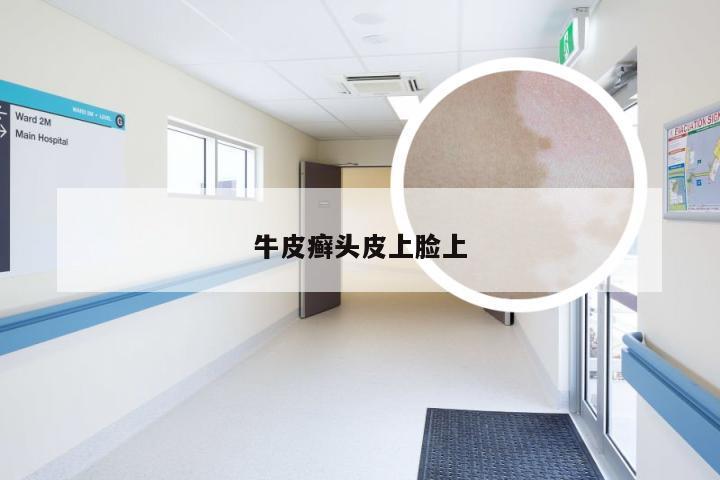 牛皮癣头皮上脸上