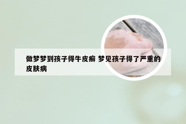 做梦梦到孩子得牛皮癣 梦见孩子得了严重的皮肤病