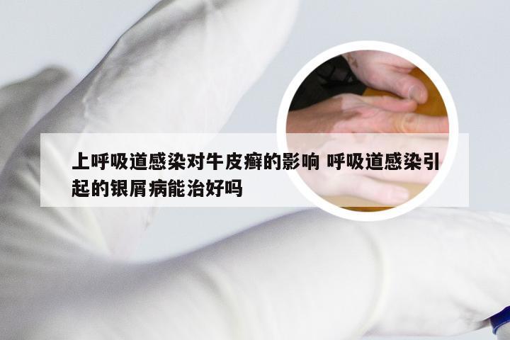 上呼吸道感染对牛皮癣的影响 呼吸道感染引起的银屑病能治好吗