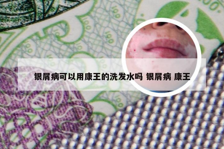 银屑病可以用康王的洗发水吗 银屑病 康王