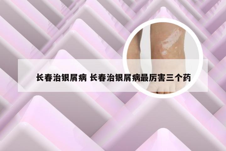长春治银屑病 长春治银屑病最厉害三个药