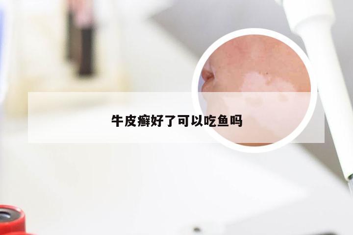 牛皮癣好了可以吃鱼吗