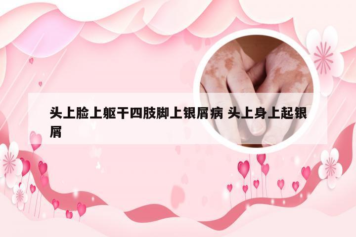 头上脸上躯干四肢脚上银屑病 头上身上起银屑