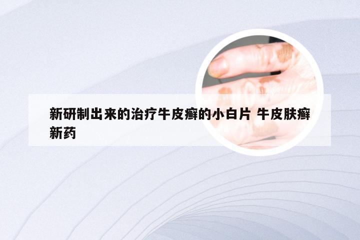 新研制出来的治疗牛皮癣的小白片 牛皮肤癣新药