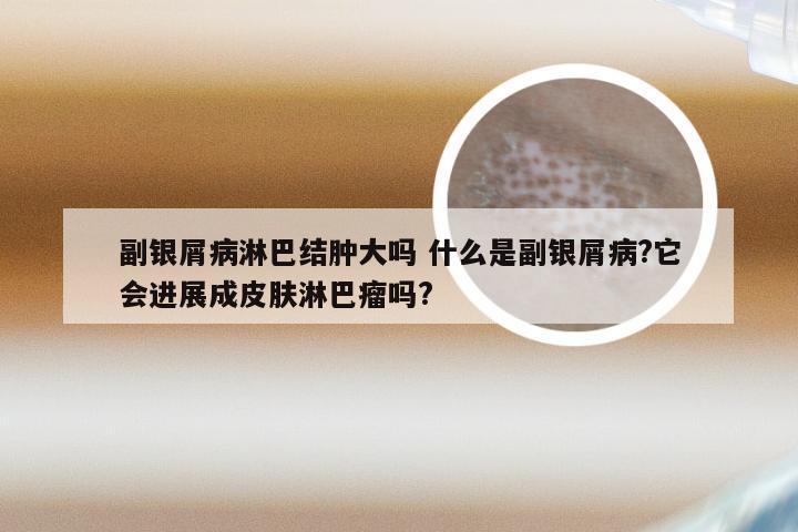 副银屑病淋巴结肿大吗 什么是副银屑病?它会进展成皮肤淋巴瘤吗?