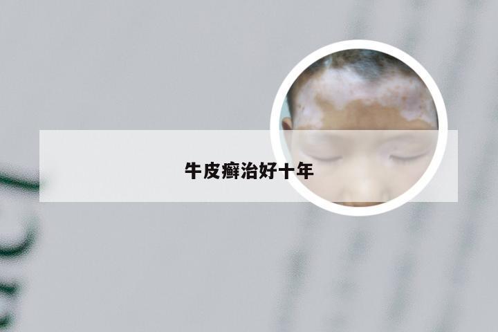 牛皮癣治好十年
