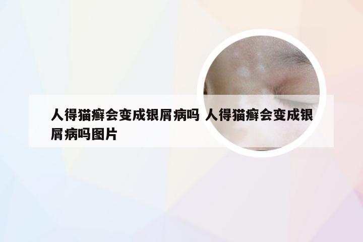 人得猫癣会变成银屑病吗 人得猫癣会变成银屑病吗图片
