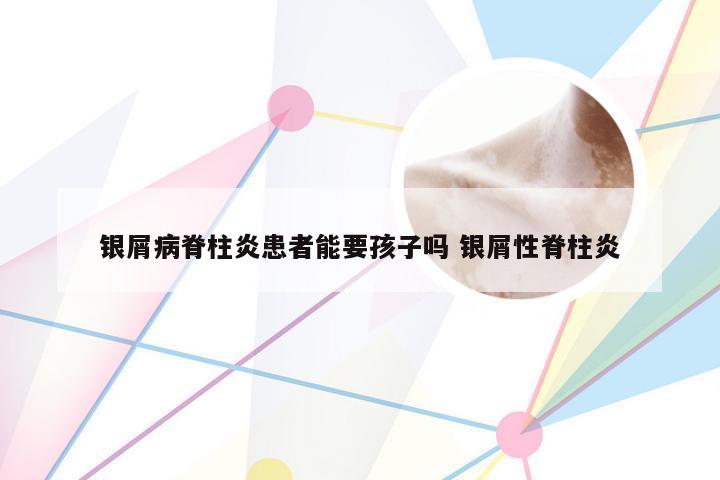 银屑病脊柱炎患者能要孩子吗 银屑性脊柱炎