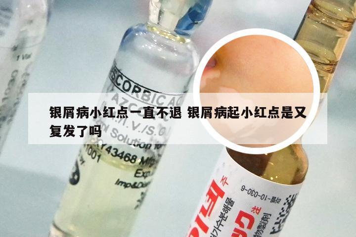银屑病小红点一直不退 银屑病起小红点是又复发了吗