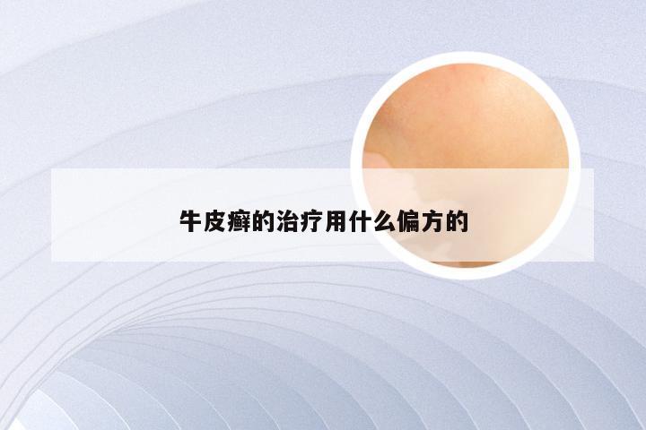 牛皮癣的治疗用什么偏方的