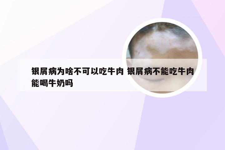 银屑病为啥不可以吃牛肉 银屑病不能吃牛肉能喝牛奶吗
