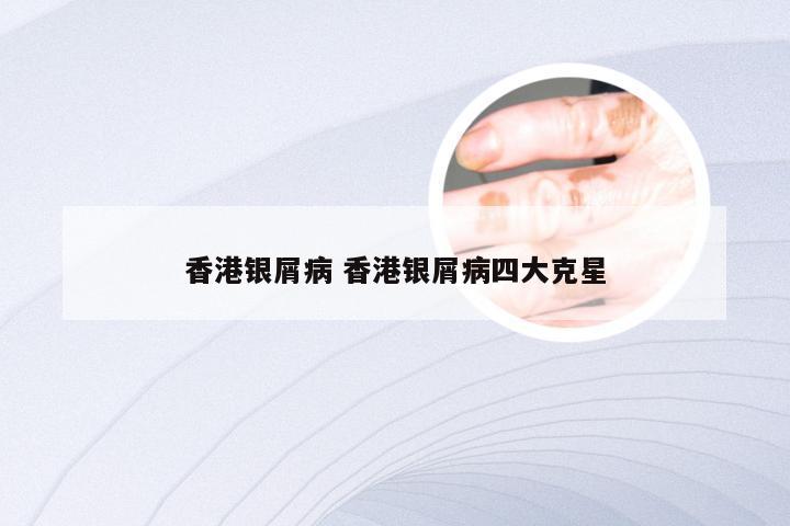 香港银屑病 香港银屑病四大克星