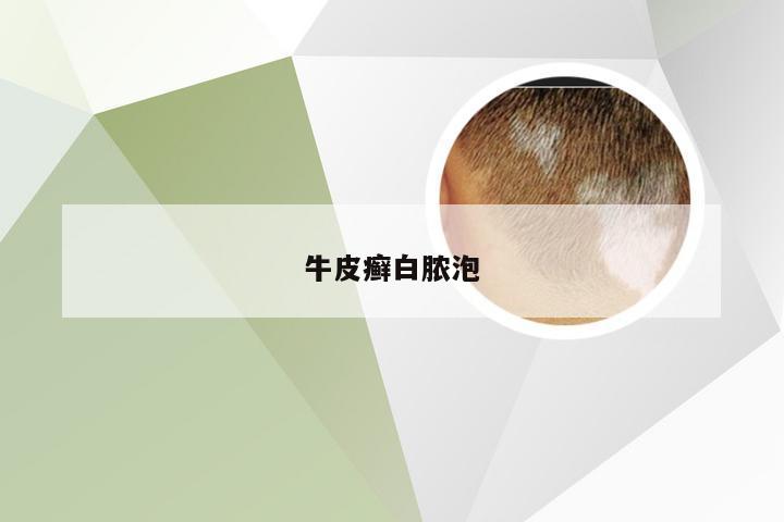 牛皮癣白脓泡