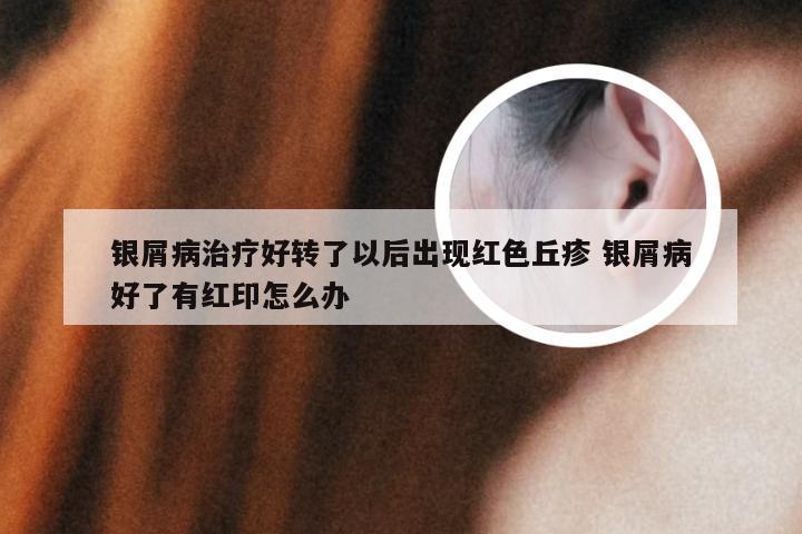 银屑病治疗好转了以后出现红色丘疹 银屑病好了有红印怎么办