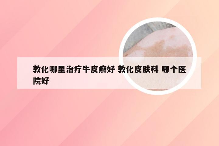 敦化哪里治疗牛皮癣好 敦化皮肤科 哪个医院好