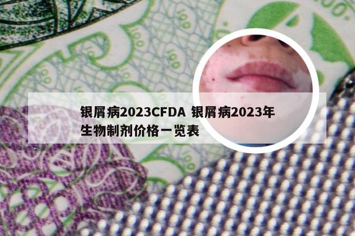 银屑病2023CFDA 银屑病2023年生物制剂价格一览表