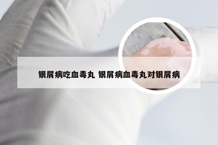 银屑病吃血毒丸 银屑病血毒丸对银屑病