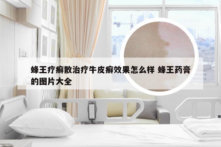 蜂王疗癣散治疗牛皮癣效果怎么样 蜂王药膏的图片大全