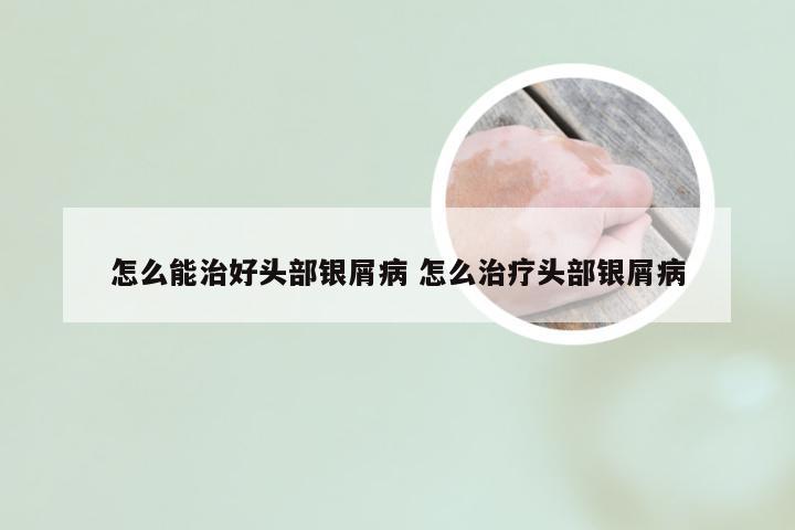 怎么能治好头部银屑病 怎么治疗头部银屑病