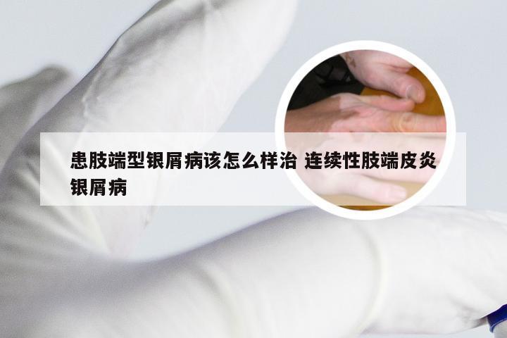 患肢端型银屑病该怎么样治 连续性肢端皮炎银屑病