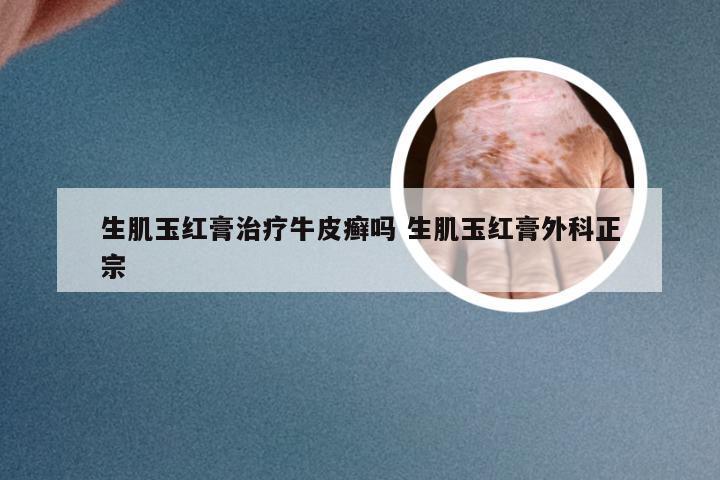 生肌玉红膏治疗牛皮癣吗 生肌玉红膏外科正宗