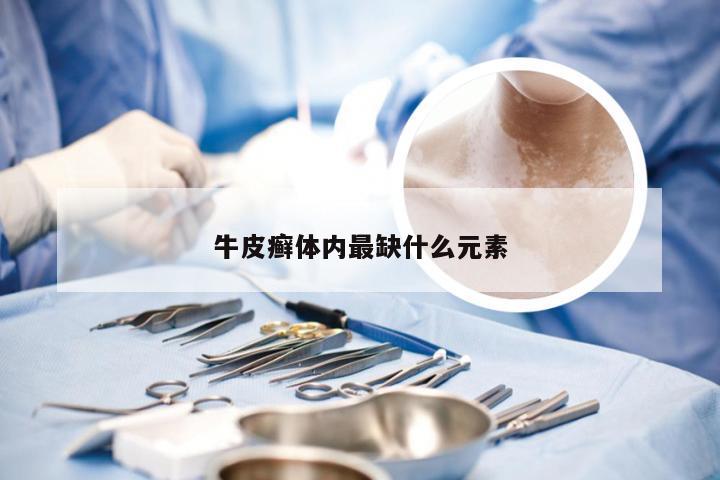牛皮癣体内最缺什么元素